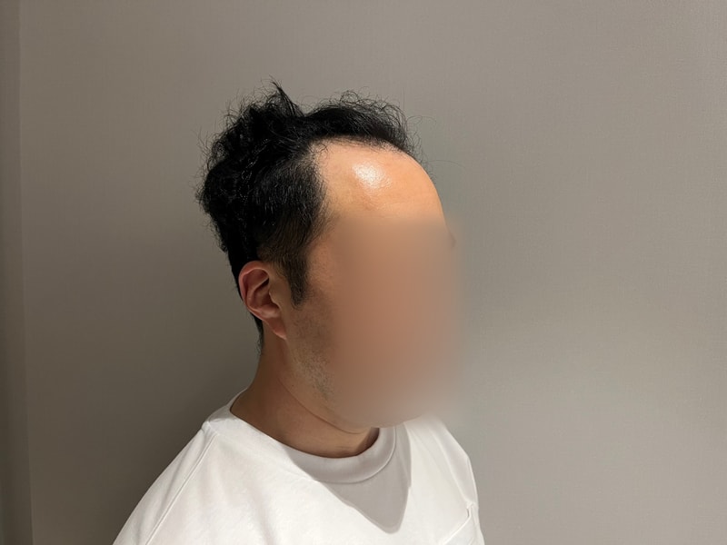 모원성형외과 M자 모발이식 1일차 [정재홍 원장님]