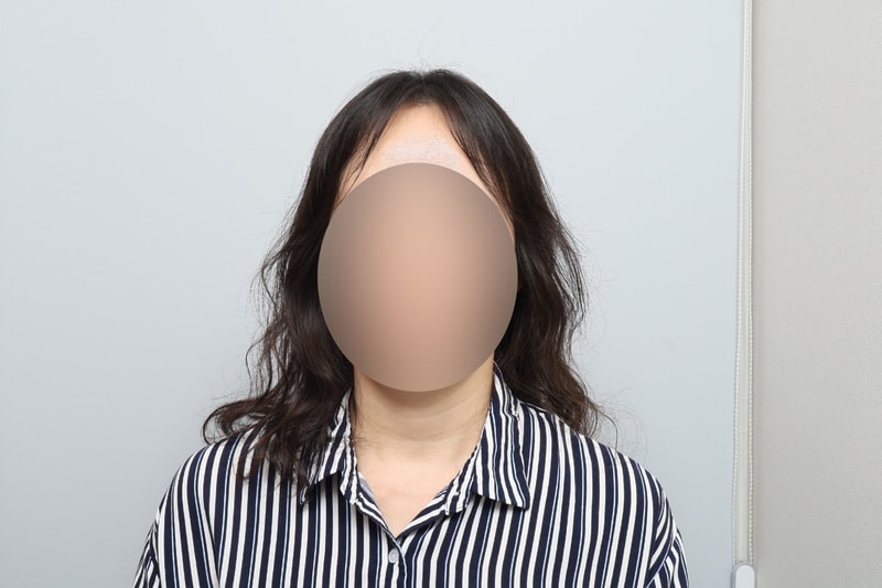 모원성형외과 헤어라인 모발이식 하루차 (박종옥원장님께 받았습니다)
