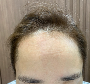 모원성형외과 부분삭발 헤어라인 모발이식 4개월<박종옥원장님>