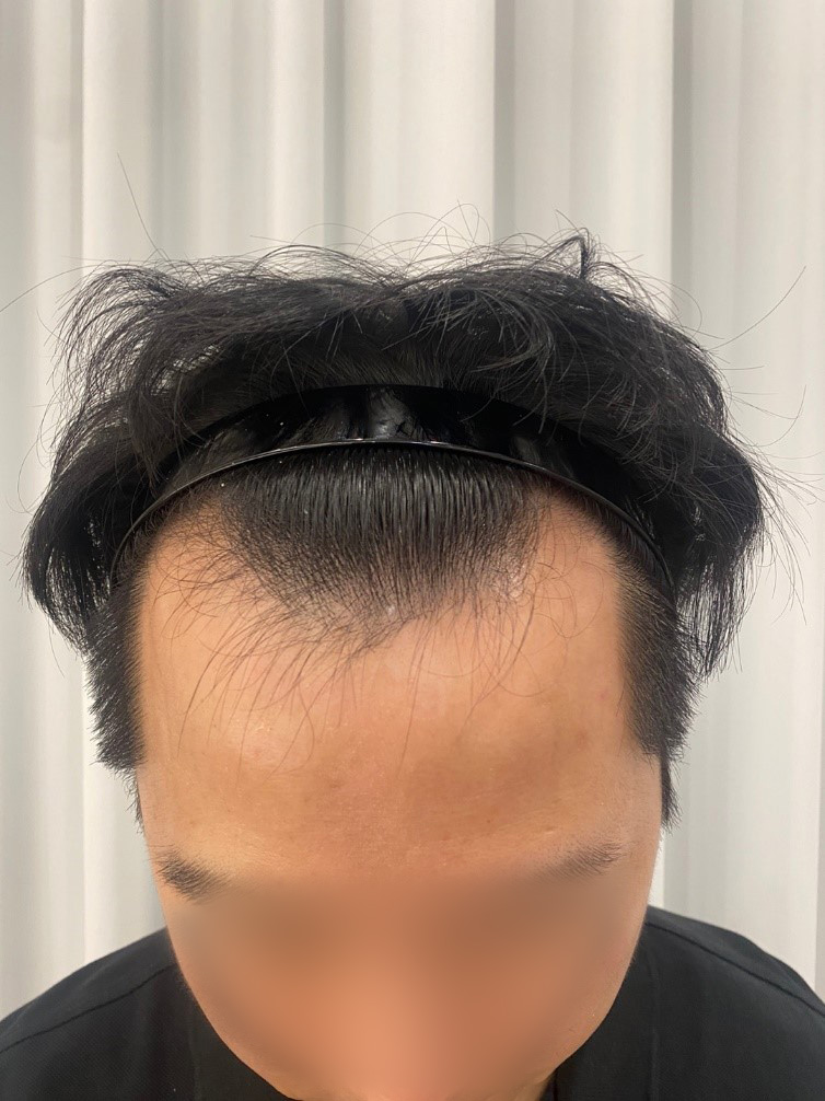 모원성형외과 투블럭 비절개 모발이식 1400모낭 4개월차 후기