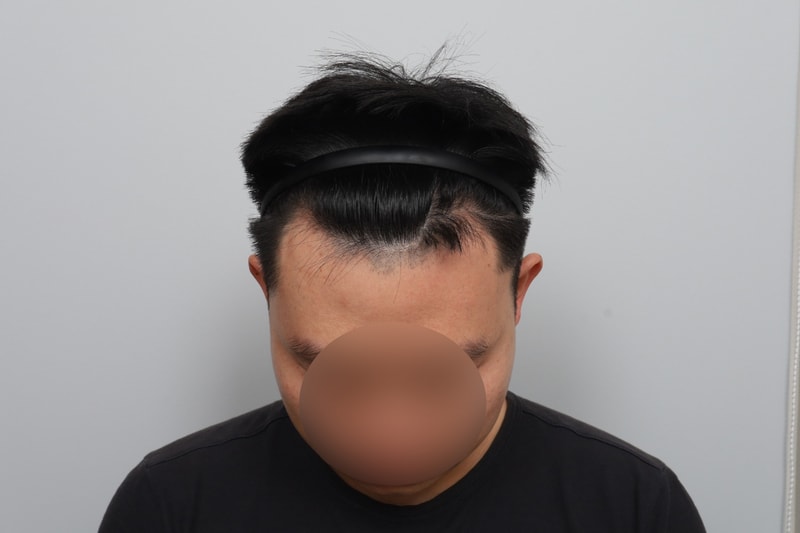 모원성형외과 M자 모발이식 12개월 완성