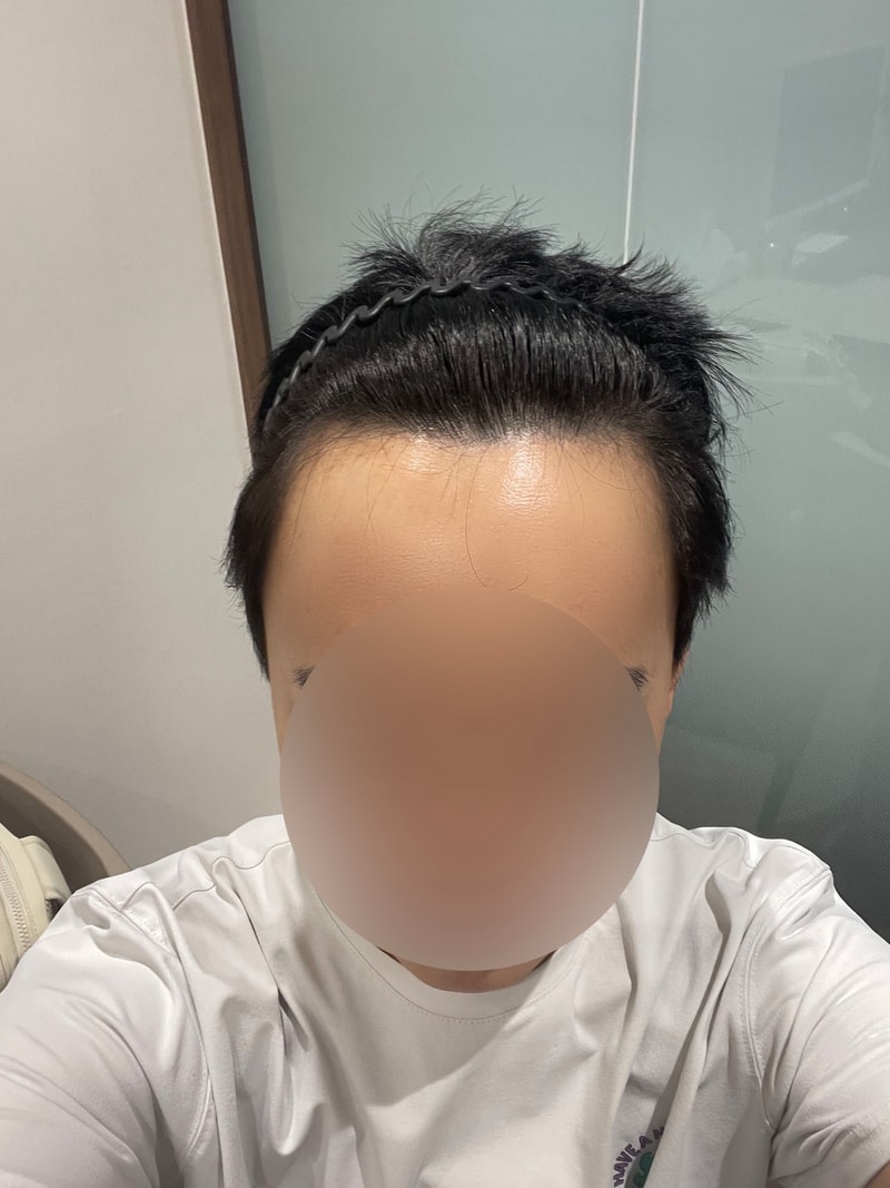 M-shaped forehead hairline 1900 hair follicle hair transplant 10 days (Sinsa Mo Won Plastic Surgery)