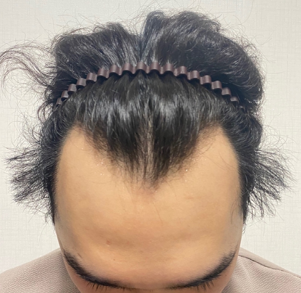 1822모낭 비절개 부분삭발 태평양 이마 탈출할 수 있을까요?