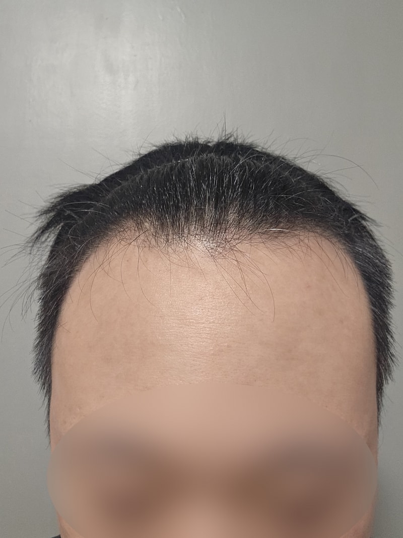 깊은 M자이마 무삭발비절개모발이식 4개월 모원성형외과 정재홍원장님