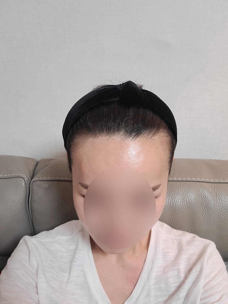 모원성형외과 여자 m자이마 비절개모발이식 7개월