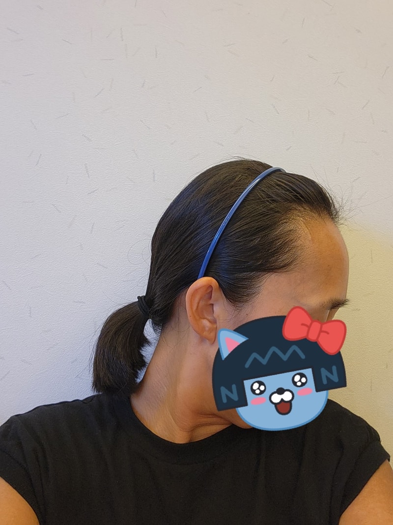 모원성형외과 헤어라인 모발이식 2일차 후기예요^^(박종옥원장님)