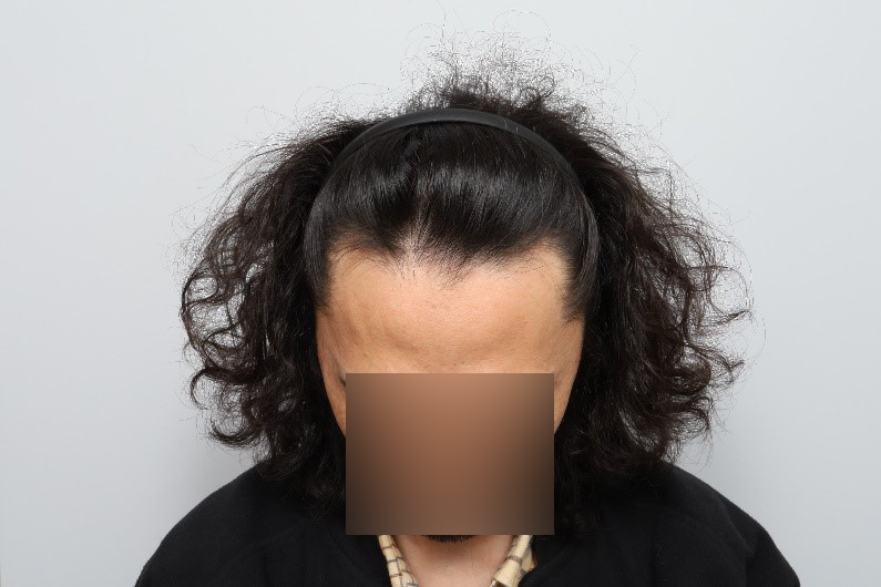 헤어라인 무삭발 비절개모발이식 7개월차 모원성형외과