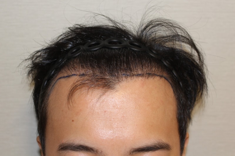 수술전 1.jpg