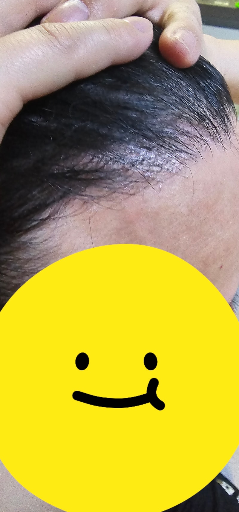 비절개 4200모 12개월 후기