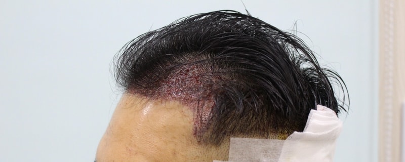 수술후 좌측.jpg