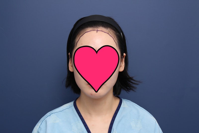 [꾸미기]박연수 수술전.JPG