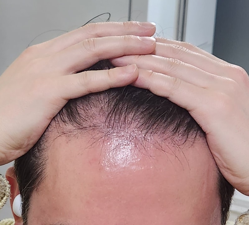 모재성 모발이식 3개월차