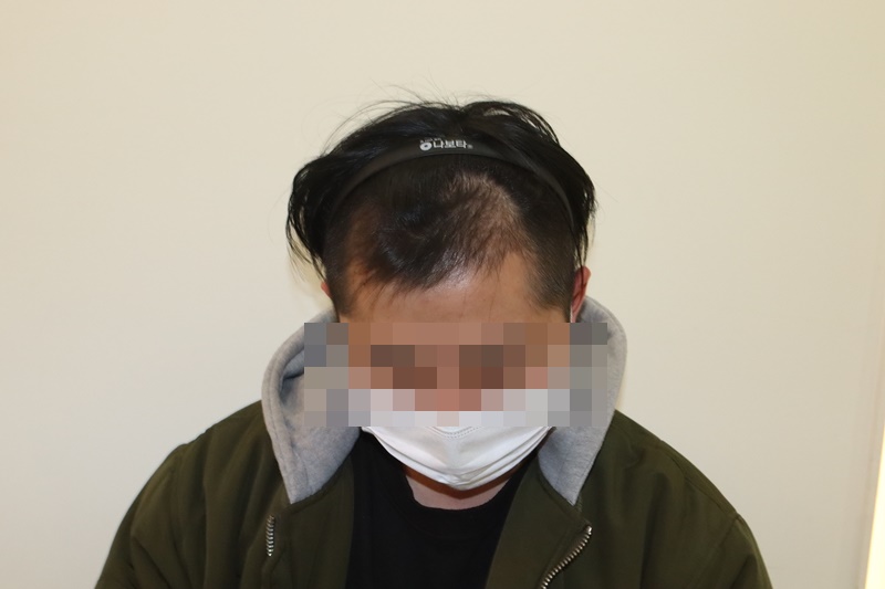 M자 4200모 모발이식 민삭 4개월 경과 후기입니다