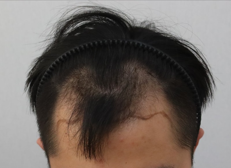 M자 4200모 모발이식 민삭 후기입니다