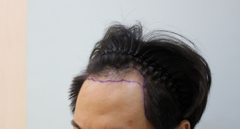 0. 시술전02.jpg