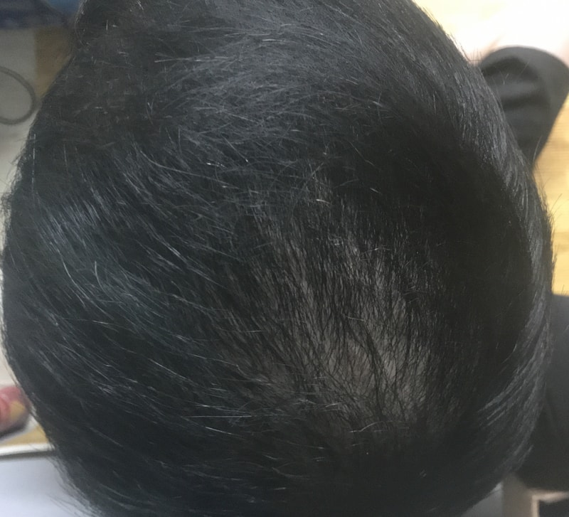 정수리 모발이식 4개월 후기