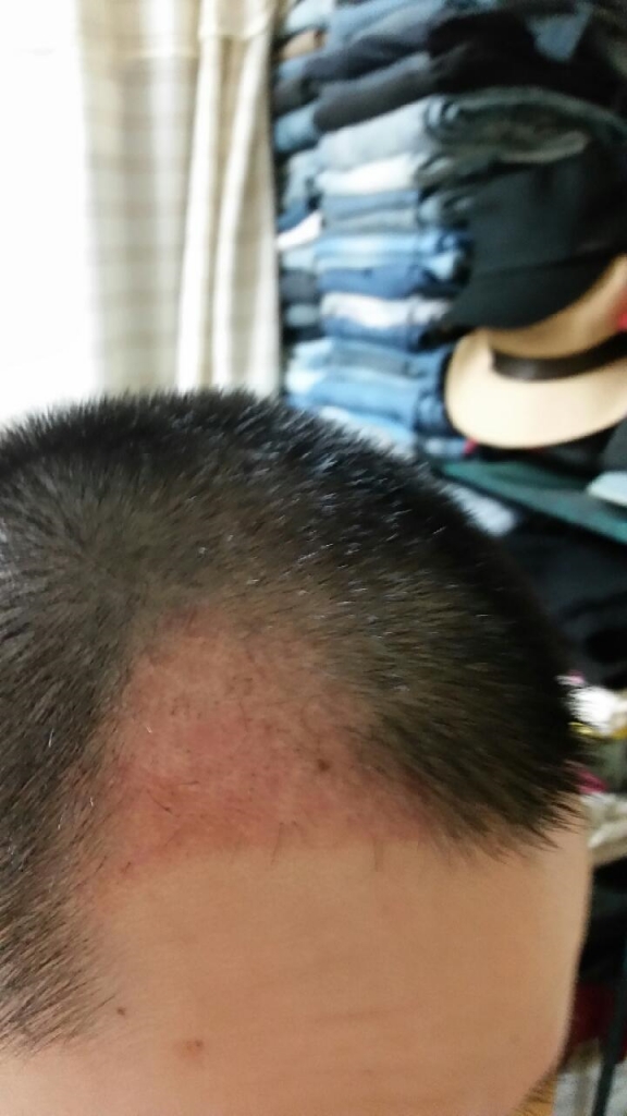 포헤어M자이식 삭발 1200모낭 35일차후기및관리!!