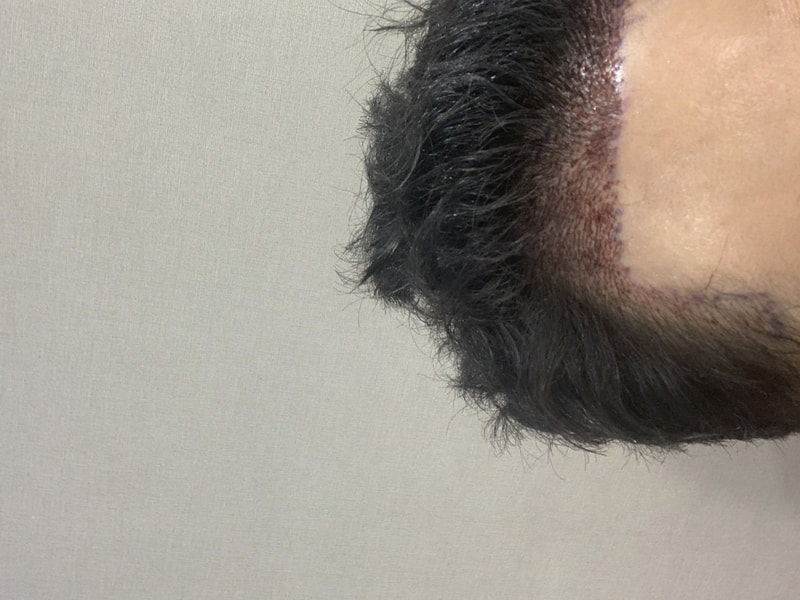 모재성 비삭발 비절개 1300모낭 수술 후기