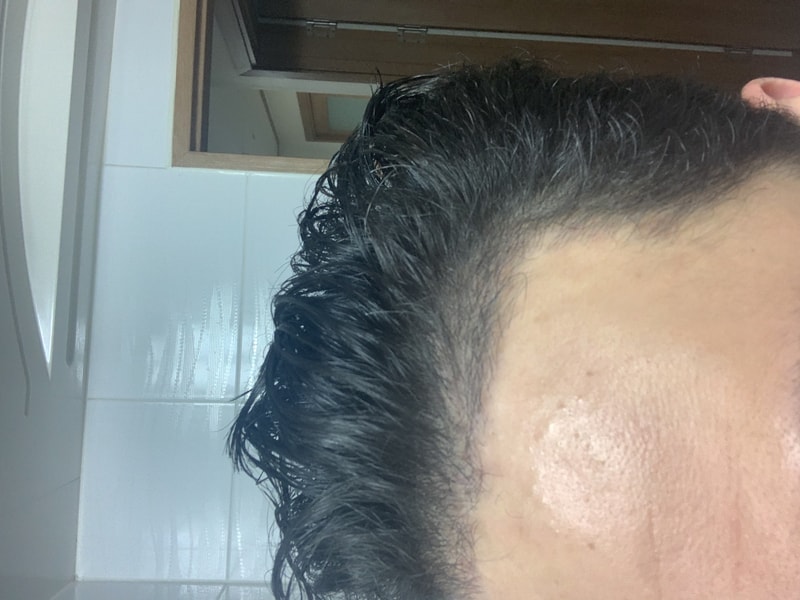 모재성 비삭발 비절개 1300모낭 3개월 후기
