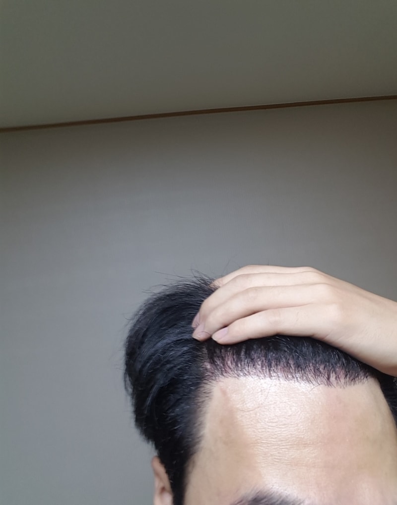 이식 7개월차2.jpg