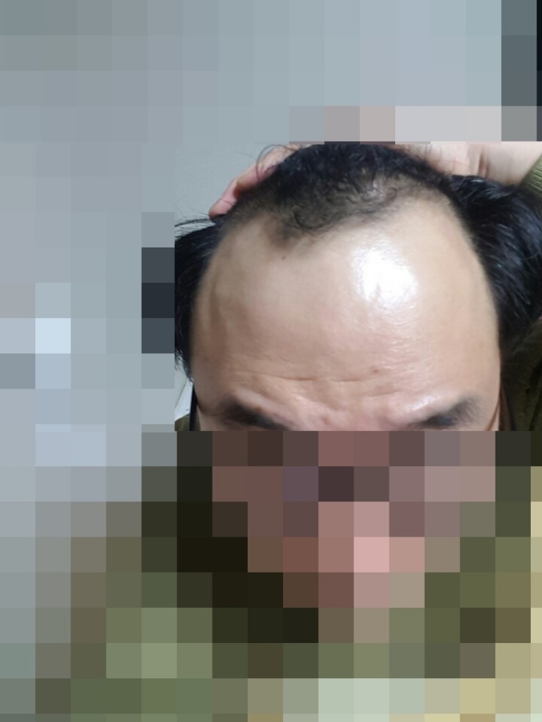 수술전11.jpg
