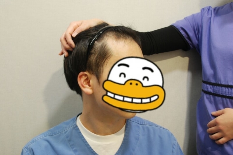 모발이식 전 옆.jpg