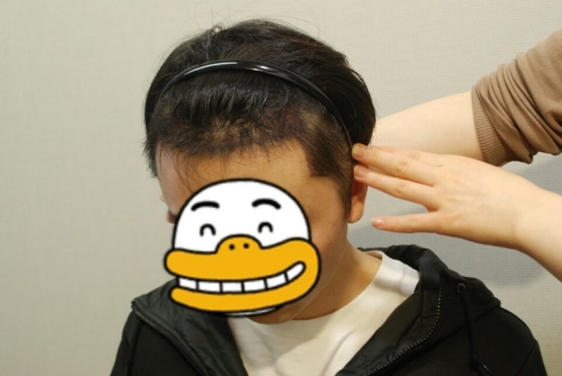모발이식 후.jpg