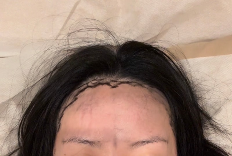 [모우림 의원] 여성헤어라인 이식 수술 후기