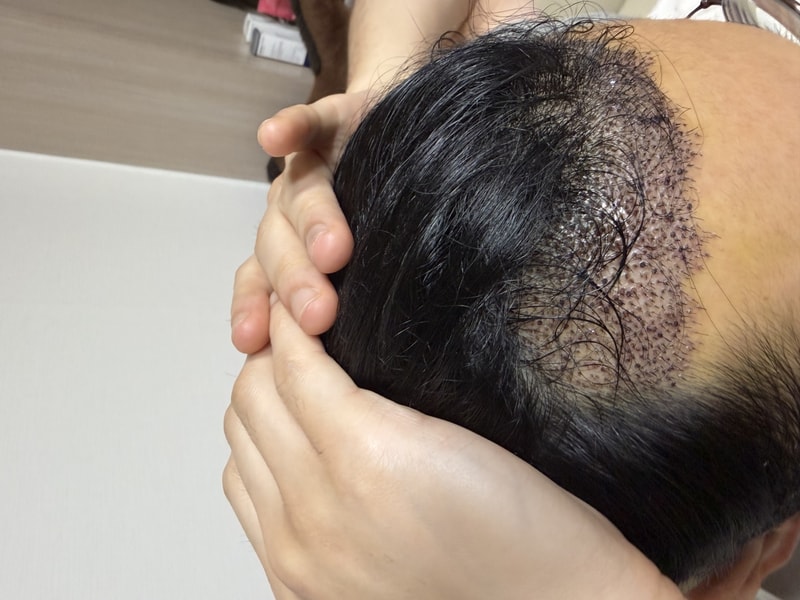 뉴헤어 5일차 비절개 1500모낭
