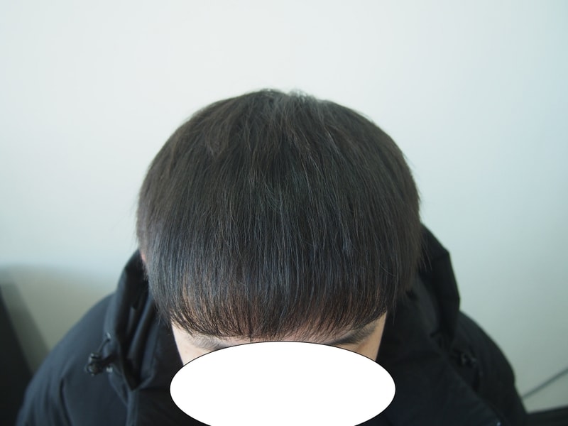 모재성 1780 모낭 8개월차
