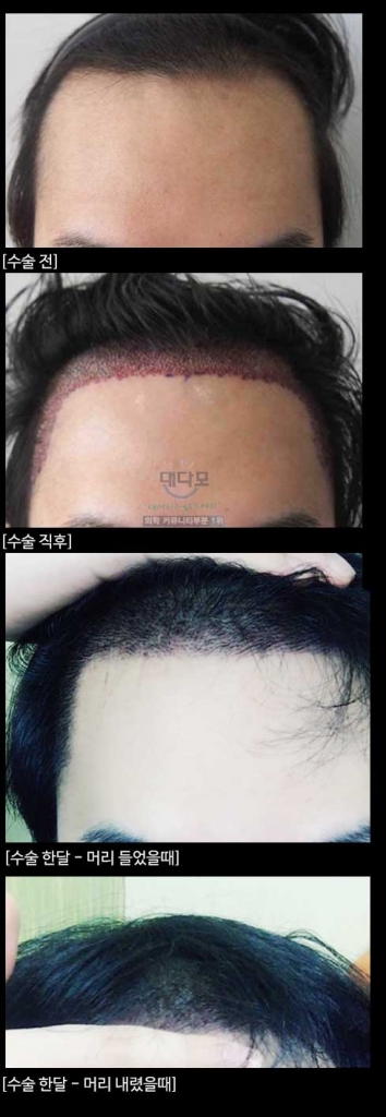 모재성 비절개 16OO모낭 수술 1개월 후