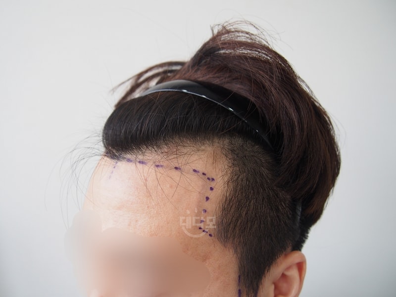 모재성 M자 이식 1년차 후기