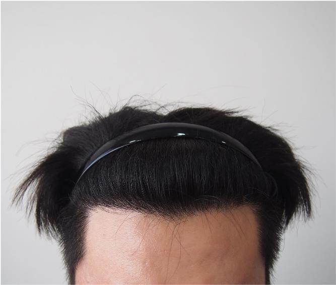 모재성 M자 이식 8개월차 후기