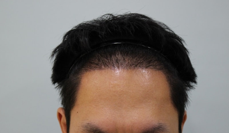 절개 10일차.jpg
