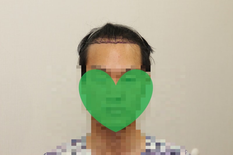 뉴헤어의원 비절개 모발이식 1년 9개월차 후기