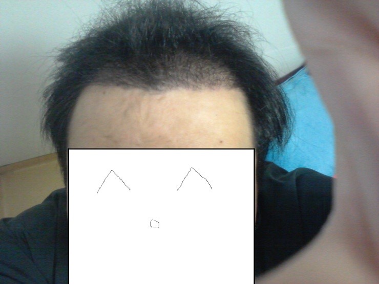 딱지제거2.jpg