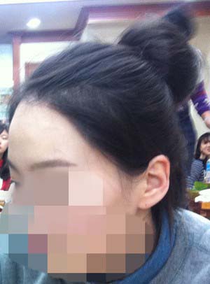 헤어라인 교정 똥머리 수정1.jpg