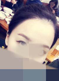 헤어라인 교정 똥머리1 수정3.jpg