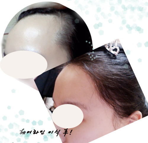 헤어라인후기1 복사--.jpg