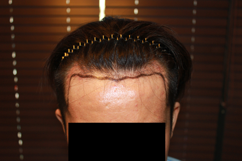 수술전 정면.jpg
