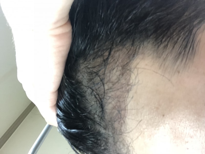 이식한지 2개월하고 일주일 지났어요
