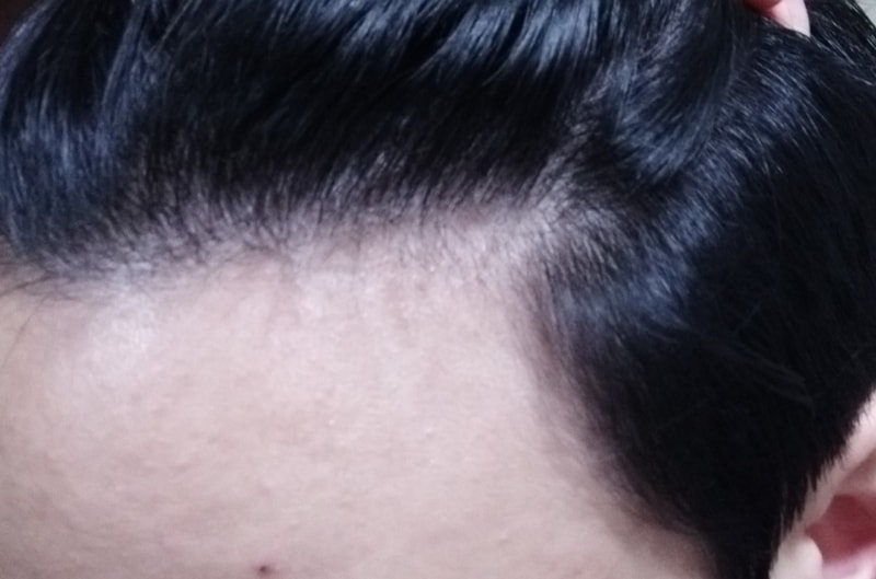 a hair transplant / one year of adot
