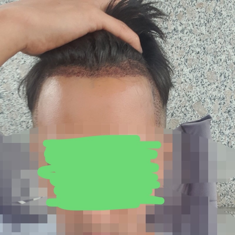 엠자 수술 다나에서 했어요