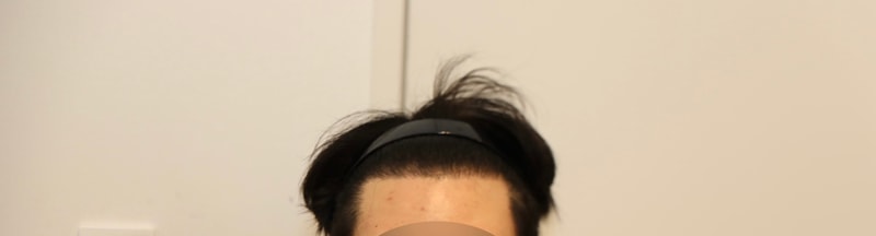 뉴헤어의원 1800모낭 7개월차 수술 후기