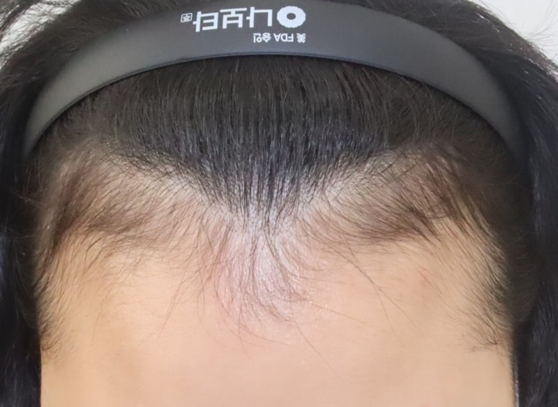 비절개 무삭발 6개월 후기