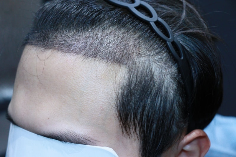 광주 압구정모비앙 모발이식 2주 경과 후기