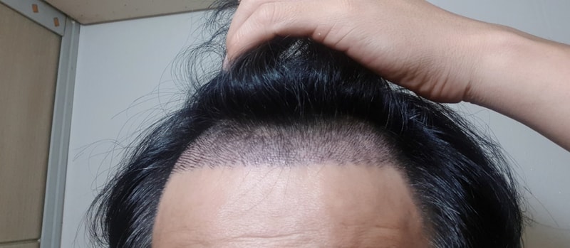 12일차 혼자 딱지제거