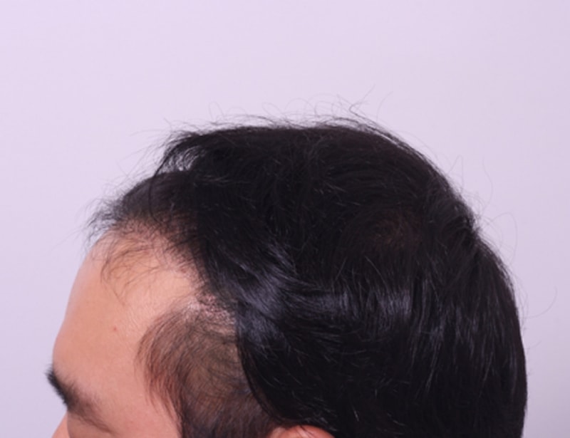 수술후(옆모습).jpg