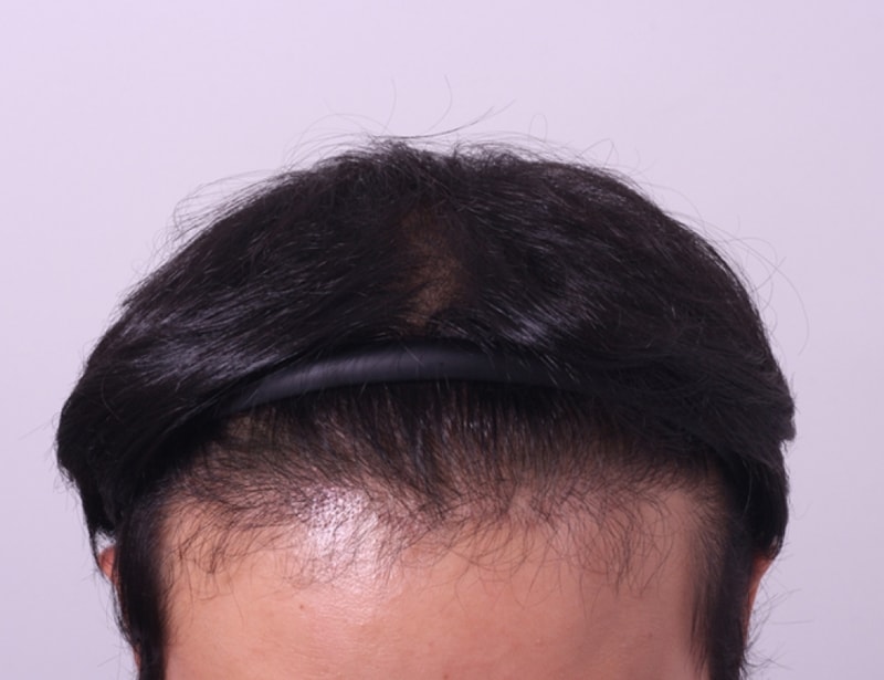 수술후정면.jpg