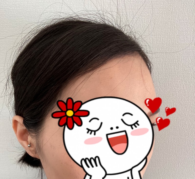 다나에서 수술했어요. 5개월~